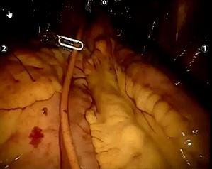 构建回肠新膀胱 用ligasure游离回肠段;  利用直线切割缝合器进行消化